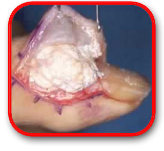 Gout Tophi